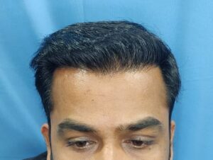 A Natural Hair Transplant Result From Jaipur