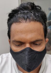A Natural Hair Transplant Result From Ahmedabad