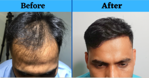 A Natural Hair Transplant Result From Delhi