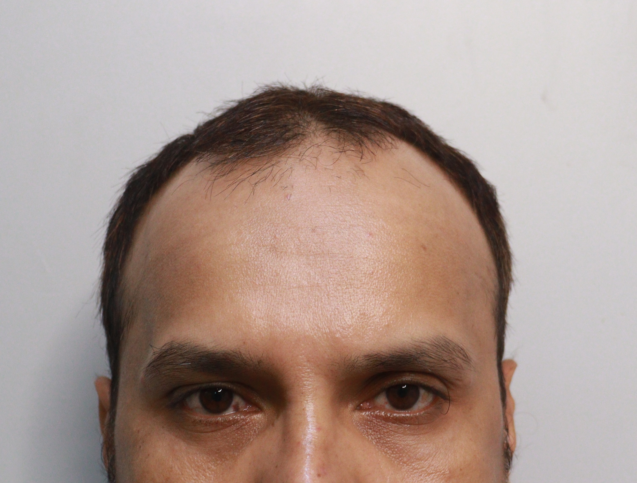 Hair Transplant from Kolkata Clinic 3400 Grafts Best Hair Help