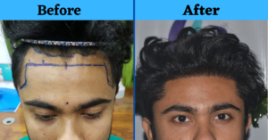 A Natural Hair Transplant Result From Kolkata