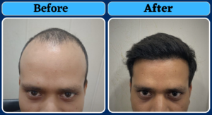 A Natural Hair Transplant Result From Jharkhand