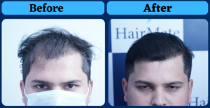 A Natural Hair Transplant Result From Pune