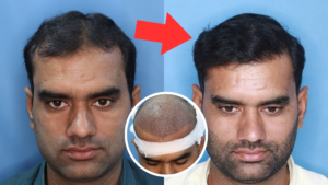 This result of hair transplant will blow your mind