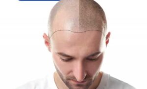 Difference Between Cheap & Affordable Hair Transplant