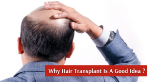 Top 10 Benefits Of Hair Transplant Surgery