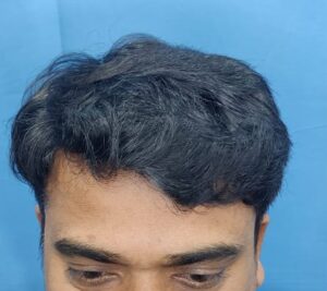 A Natural Hair Transplant Result From Jaipur