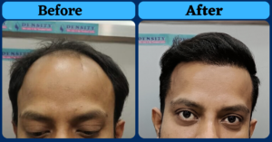 A Natural Hair Transplant Result From Jharkhand