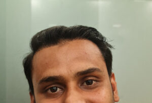 Hair Transplant Results of Mr. Azad From Ahmedabad