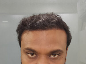 Hair Transplant Results of Mr. Naresh From Ahmedabad