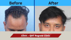 A Natural Hair Transplant Result From Haridwar