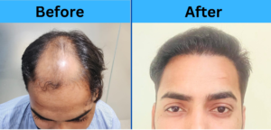 A Natural Hair Transplant Result From Delhi