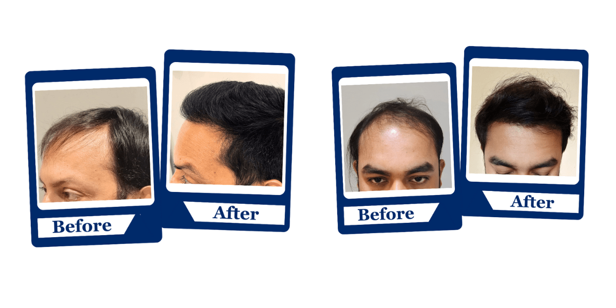 The Science Behind Hair Transplants How It Works and Why It’s