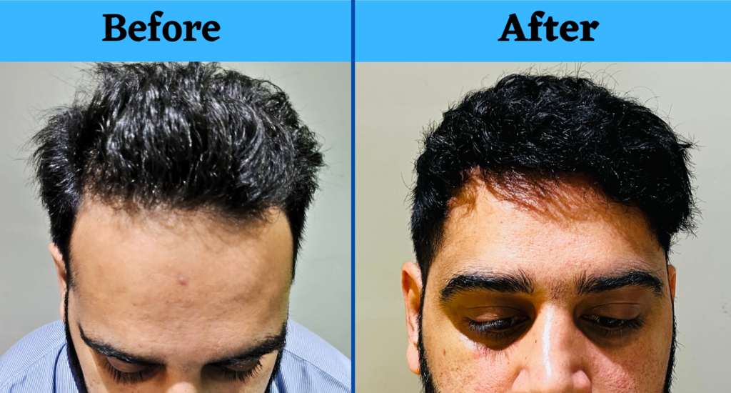 The best Hair Fall solution for men  VPlant Advanced Hair Care Clinics