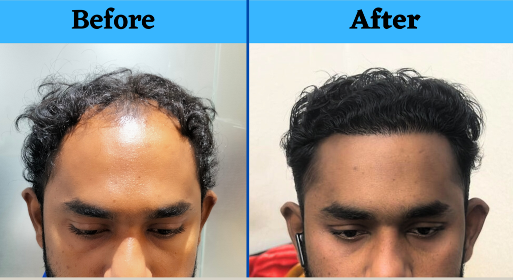 Restore Your Confidence with Hair Transplant  panacea Global hair Services