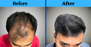 Best Hair Transplant Result From Jharkhand