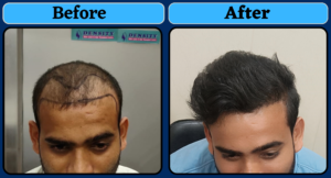 Getting Best Hair Transplant Result From Jharkhand
