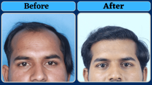 Most Natural Hairline Created By Interlocking FUE Technique