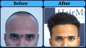 A Natural Hair Transplant Result From Pune