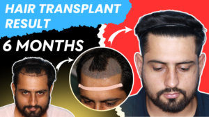 Shocking Hair Transplant Result In 6 Months