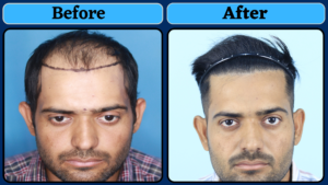 This Hair Transplant Result Is A Masterpiece !!