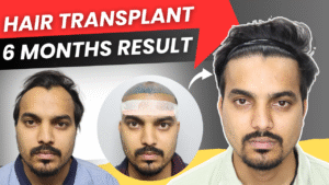 A Natural Hair Transplant Result From Delhi